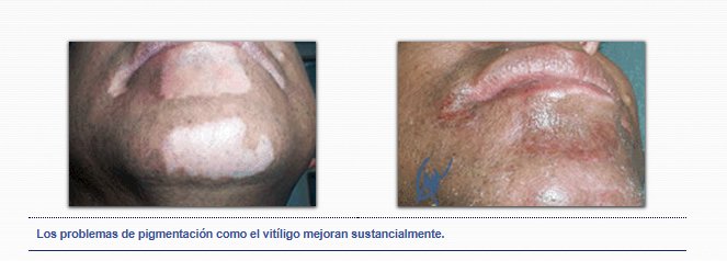 Vitíligo