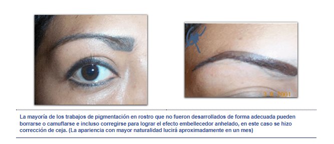 Corrección ceja